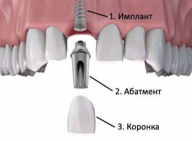 z-chogo-skladaetsya-zubnyy-implant