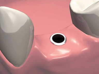 1-etap-implantacii-zuba