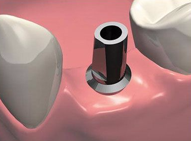 2-etap-implantacii-zuba
